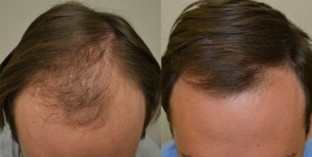 Le propecia finasteride contre la chute des cheveux