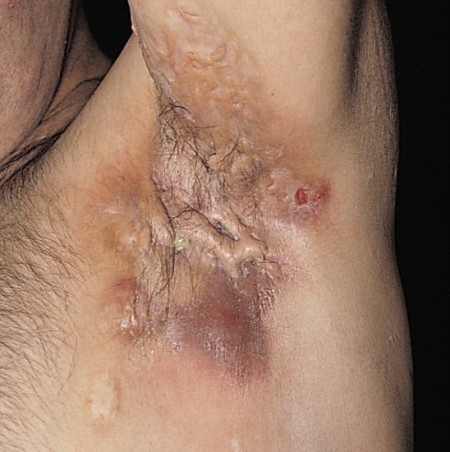 Maladie de Verneuil: inflammation de la peau en sueur