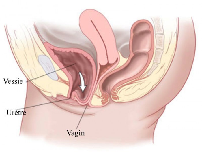 Traitement, rééducation et chirurgie contre la descente d'organes